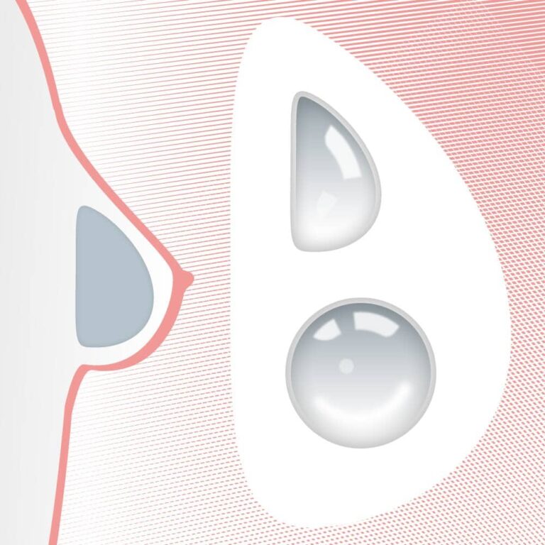 Brustimplantat tropfenförmig