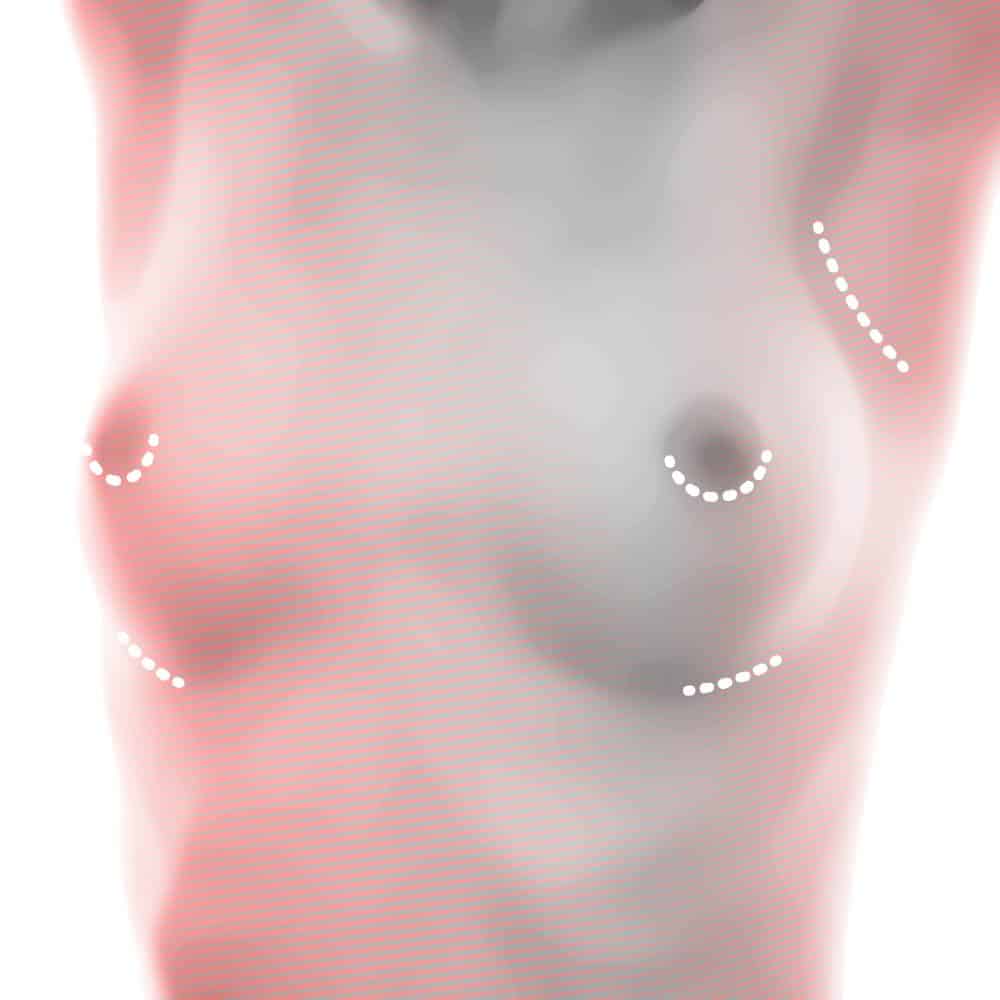 Brust Schnittführung